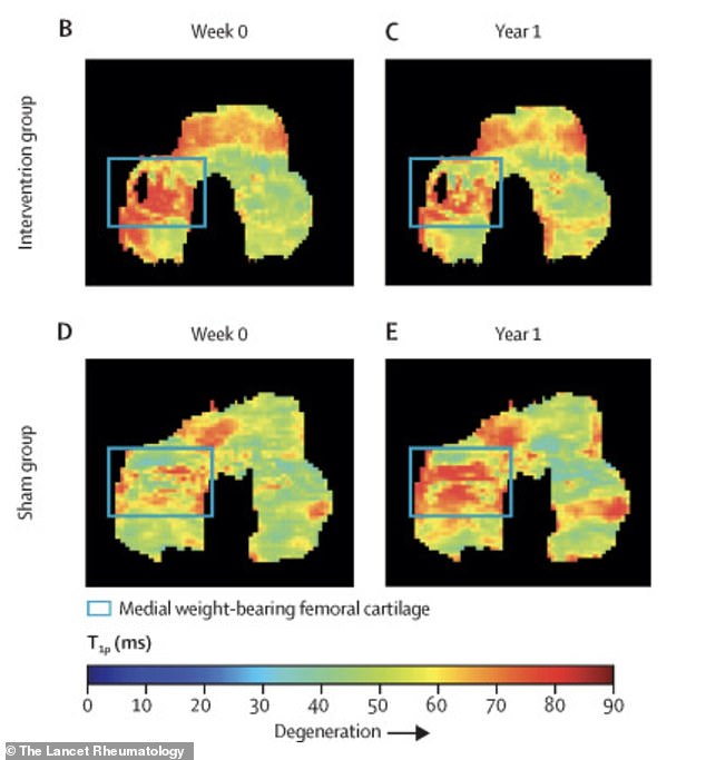 Simple Walking Angle Adjustments Can Reduce Knee Arthritis Pain